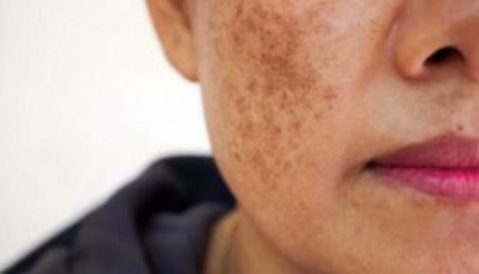 ابداع روشی برای تشخیص ابتلا به سرطان پوست در یک دقیقه